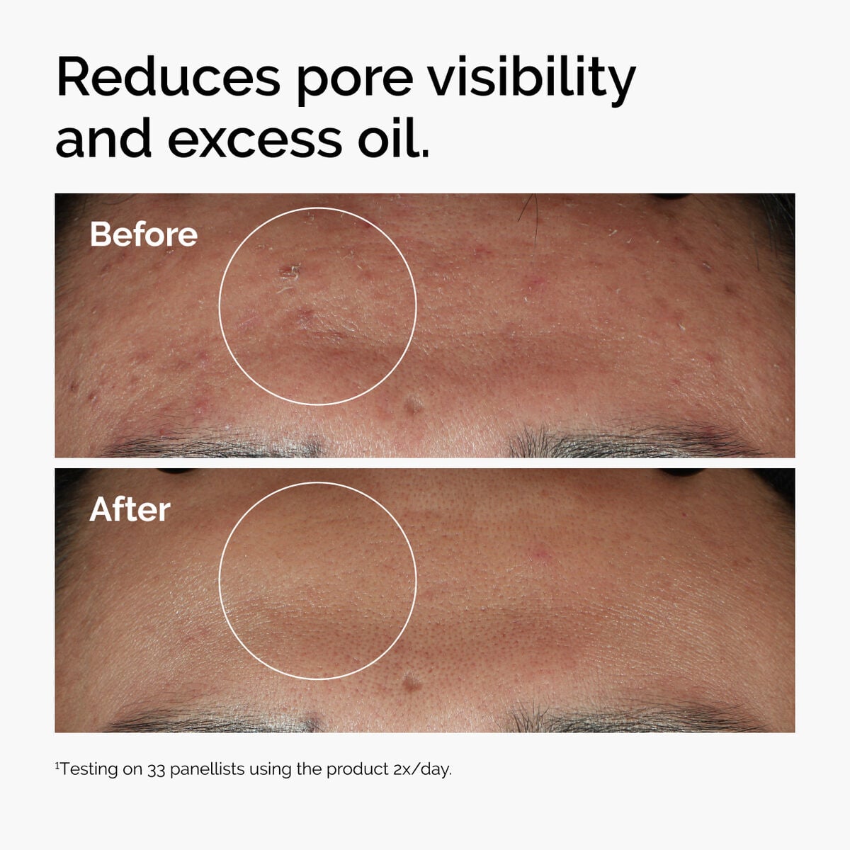 niacinamide-10-zinc-1-t6 ord-niacinamide-zinc-blemish-serum-before-after-pores.jpg