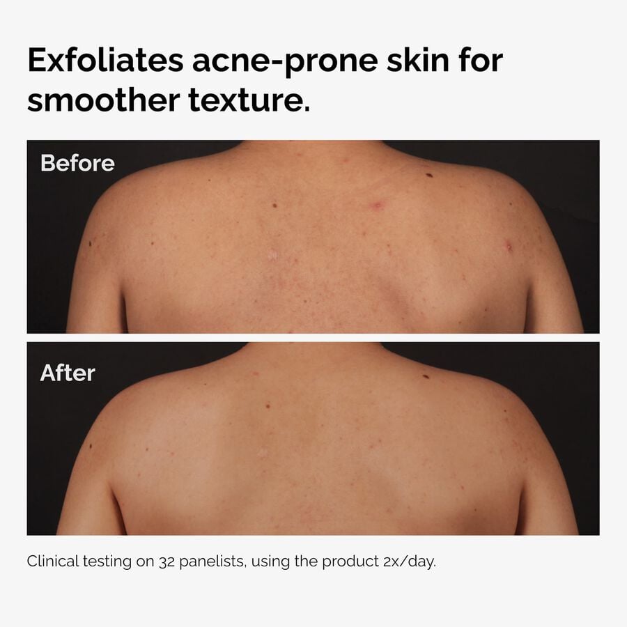 the-body-care-collection-f8 ord-salicylic-acid-body-serum-before-after-graphic-NA.jpg