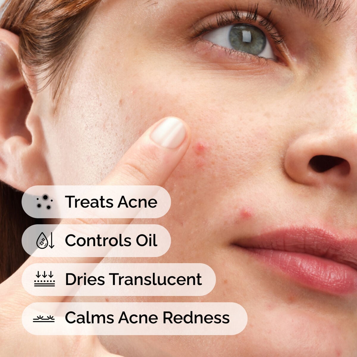sulfur-10-powder-to-cream-concentrate-s2 ord-sulfur-10pct-powder-to-cream-concentrate-model-application-with-benefits-acne.jpg