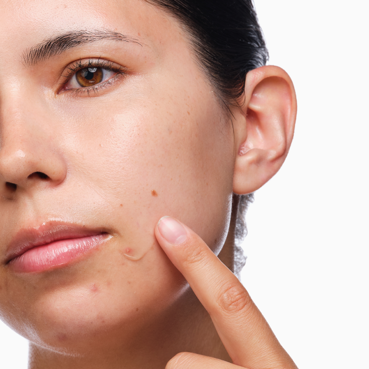 the-acne-set-x4 rdn-the-acne-set-application.png